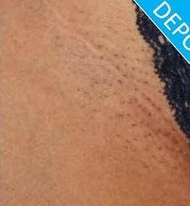 Antes e depois do clareamento de virilha 2